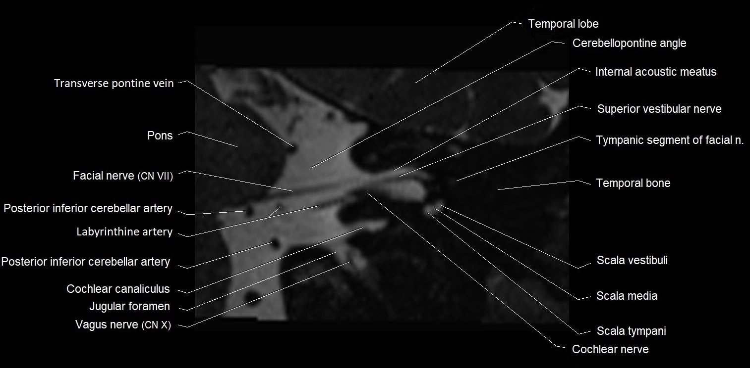 MRI Internal auditory meatus (IAM) coronal cross sectional labelled anatomy image 12.webp